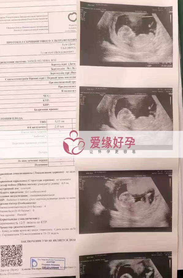 哈萨克斯坦代孕代母孕12周NT检查顺利通过