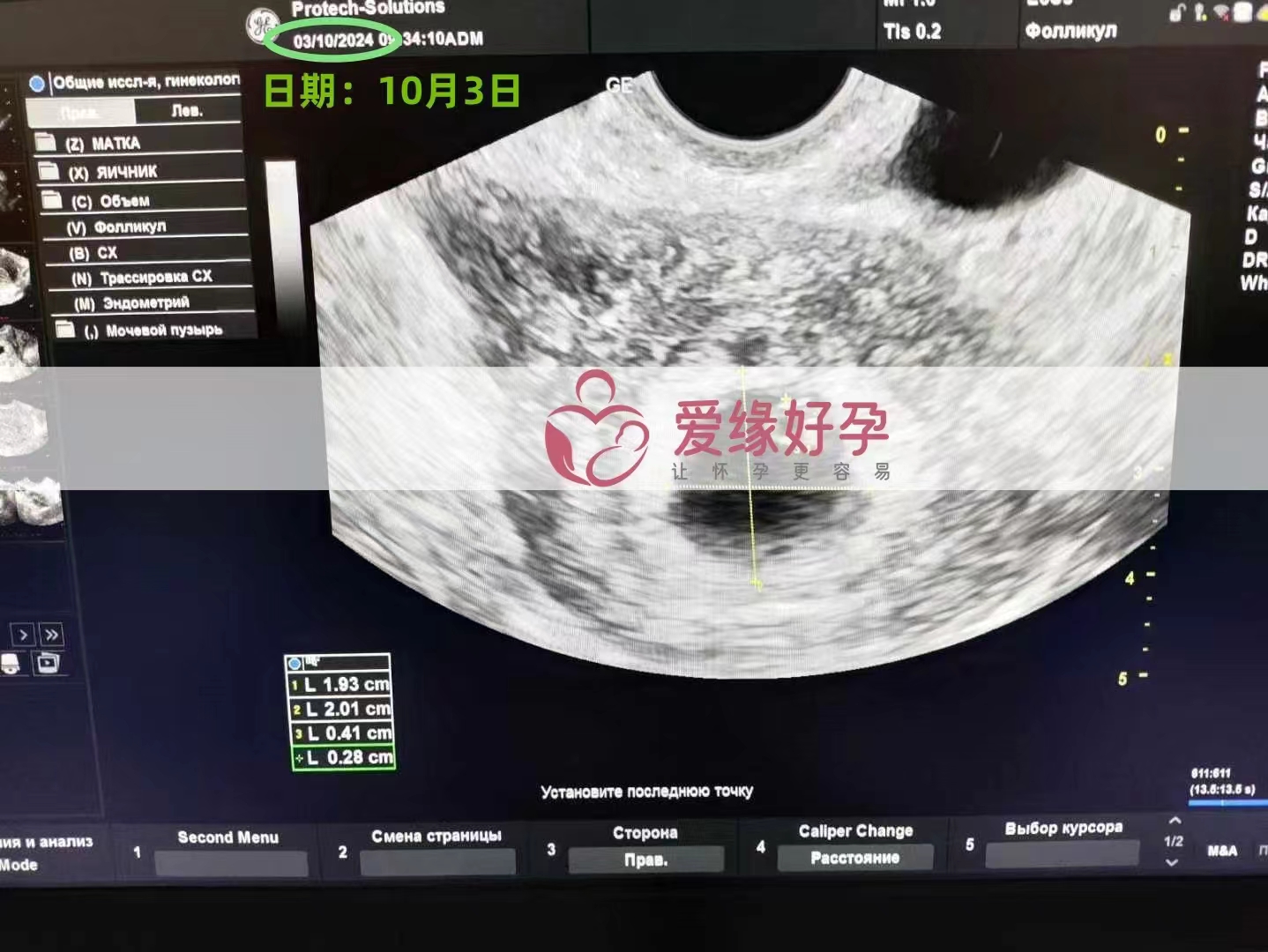 乌克兰代孕代母孕30周产检顺利通过