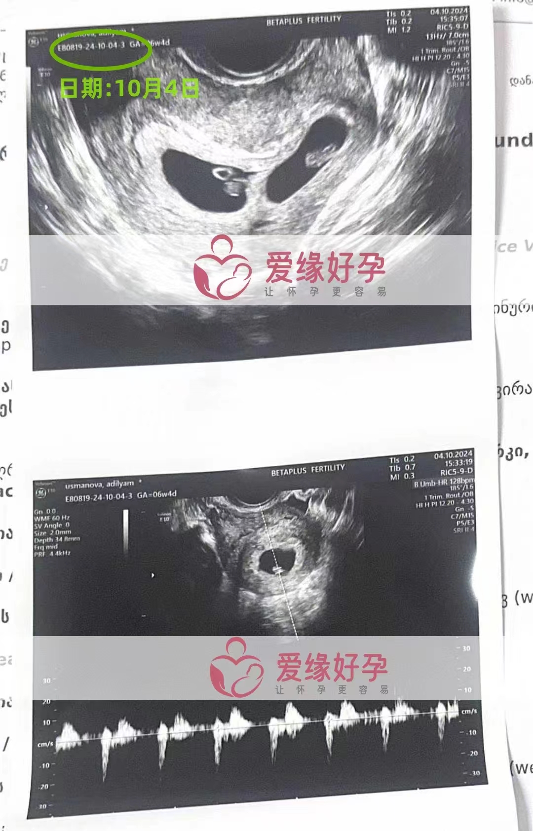 格鲁吉亚代孕代母的双胞胎孕6周产检顺利通过
