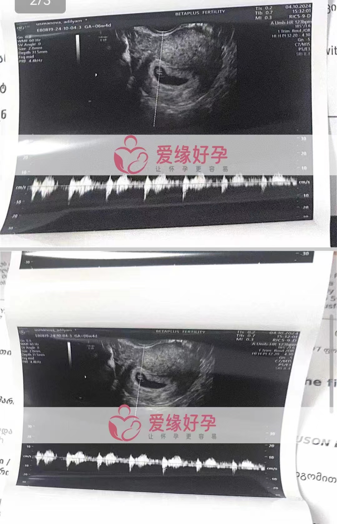 格鲁吉亚代孕代母的双胞胎孕6周产检顺利通过