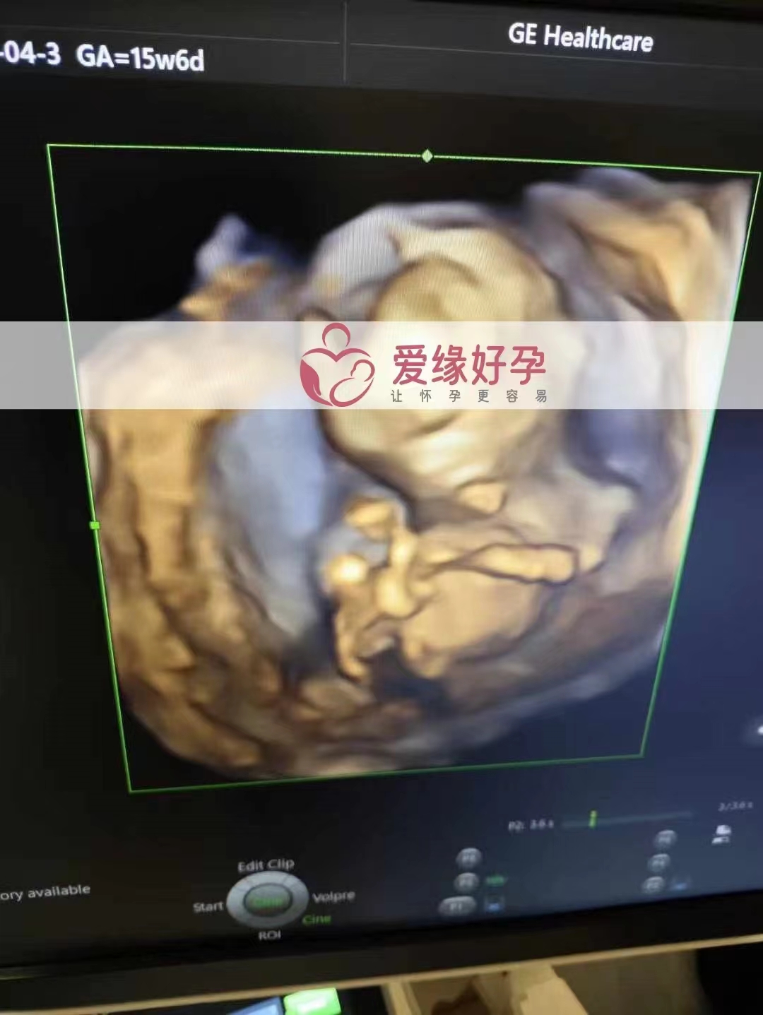 乌克兰代孕代母孕16周产检顺利通过