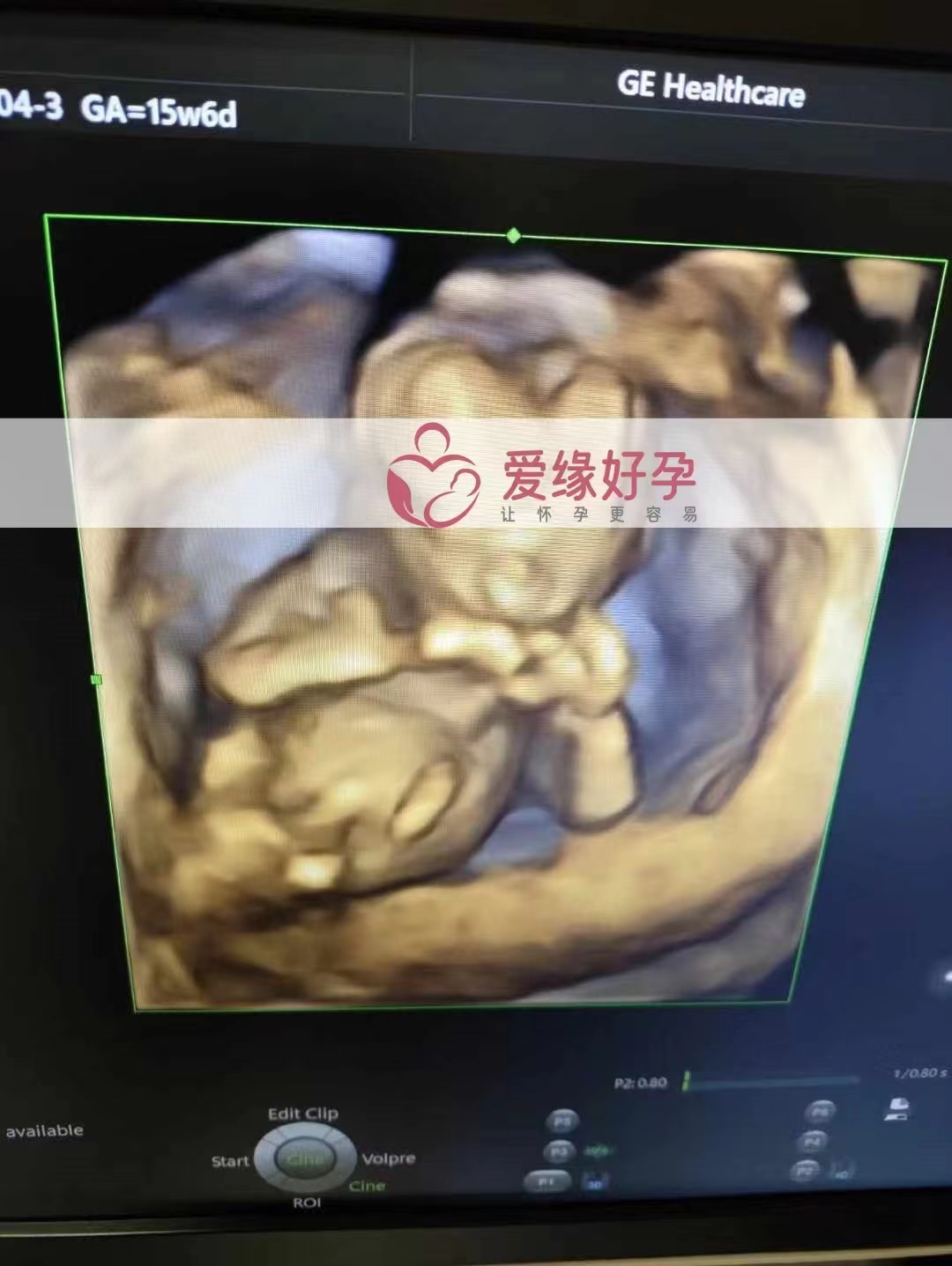 乌克兰代孕代母孕16周产检顺利通过
