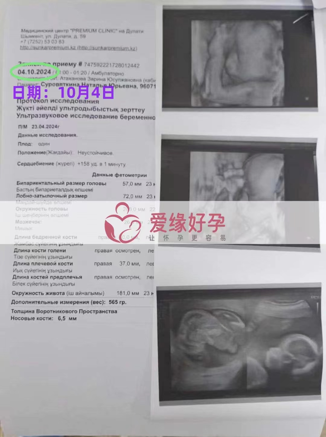 哈萨克斯坦代孕代母孕24周产检顺利通过