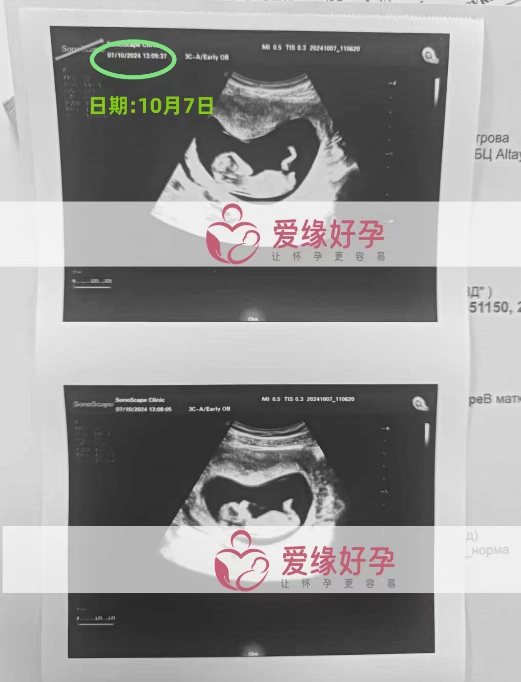 哈萨克斯坦代孕代母孕13周产检顺利通过