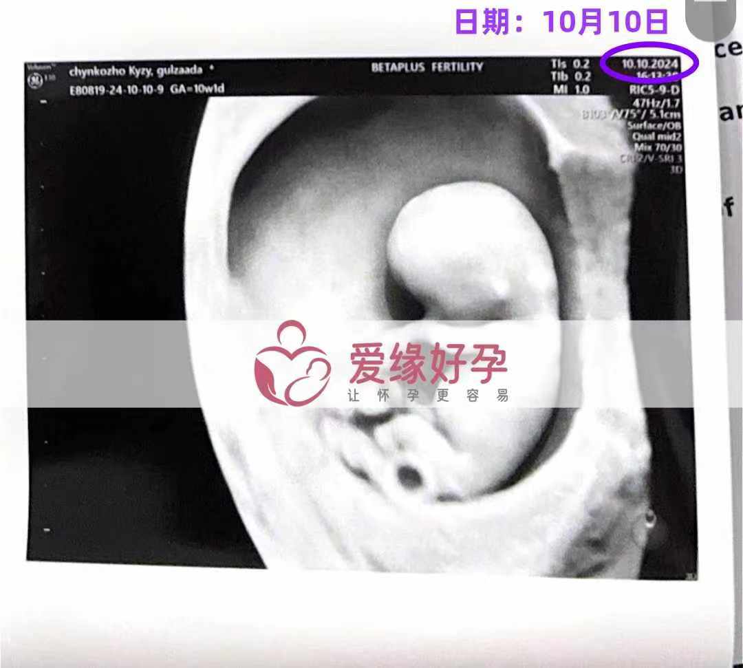 格鲁吉亚代孕代母孕10周产检顺利通过