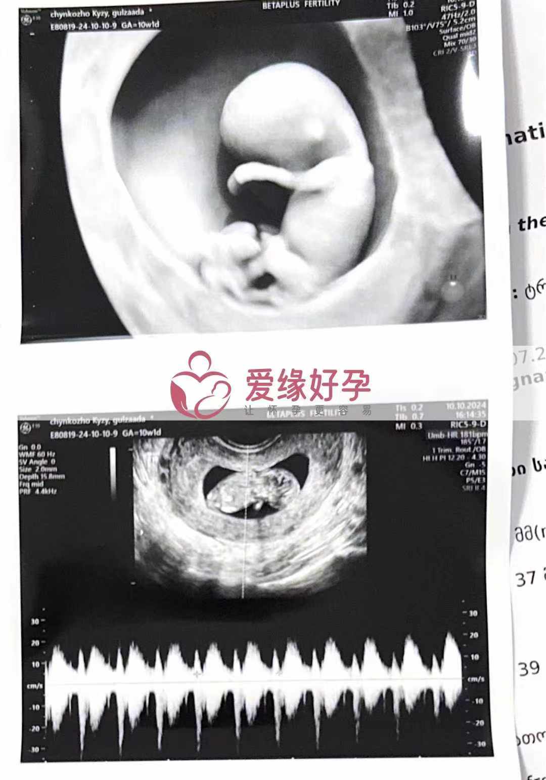 格鲁吉亚代孕代母孕10周产检顺利通过