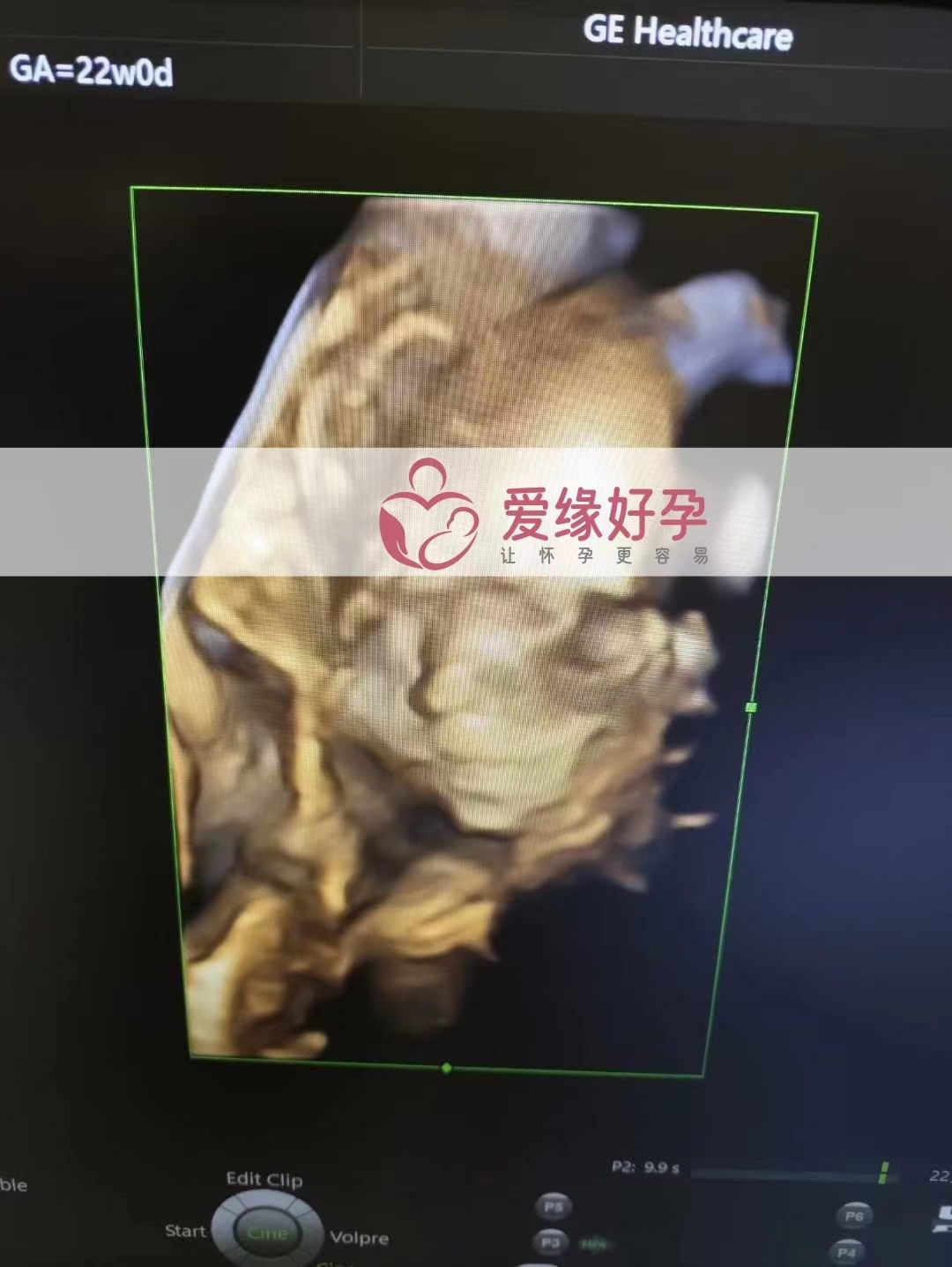 乌克兰代孕代母孕22周产检顺利通过