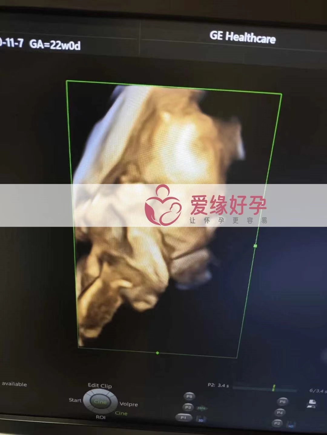 乌克兰代孕代母孕22周产检顺利通过
