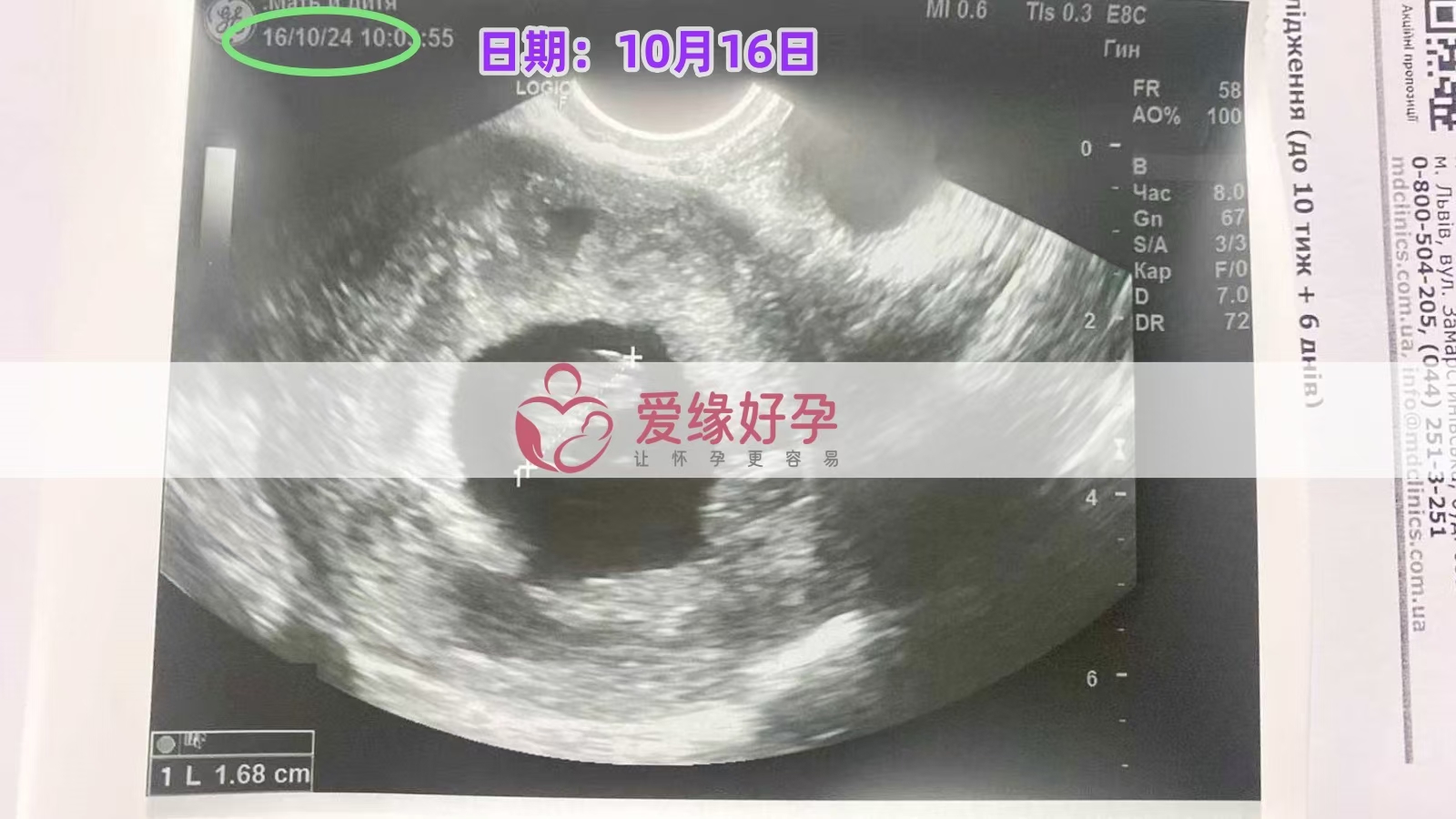 乌克兰代孕代母孕8周产检顺利通过