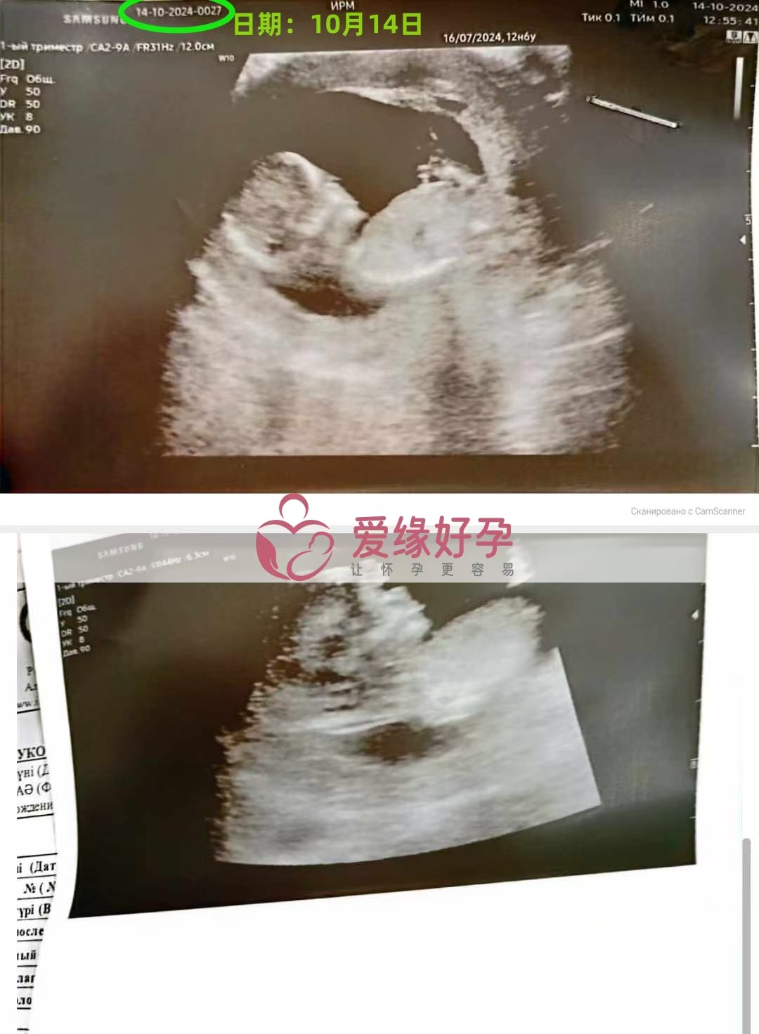 格鲁吉亚代孕代母孕12周产检顺利通过