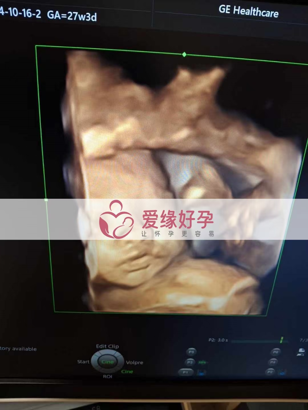 乌克兰代孕代母孕27周产检顺利通过