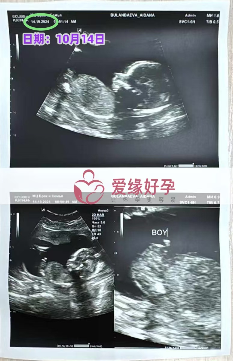 哈萨克斯坦代孕代母孕16周产检顺利通过。