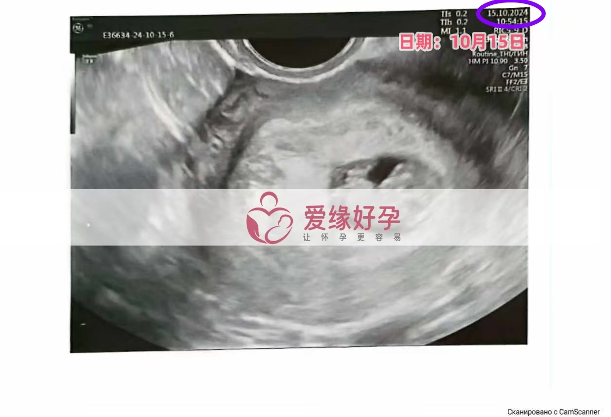 格鲁吉亚代孕代母孕8周产检顺利通过