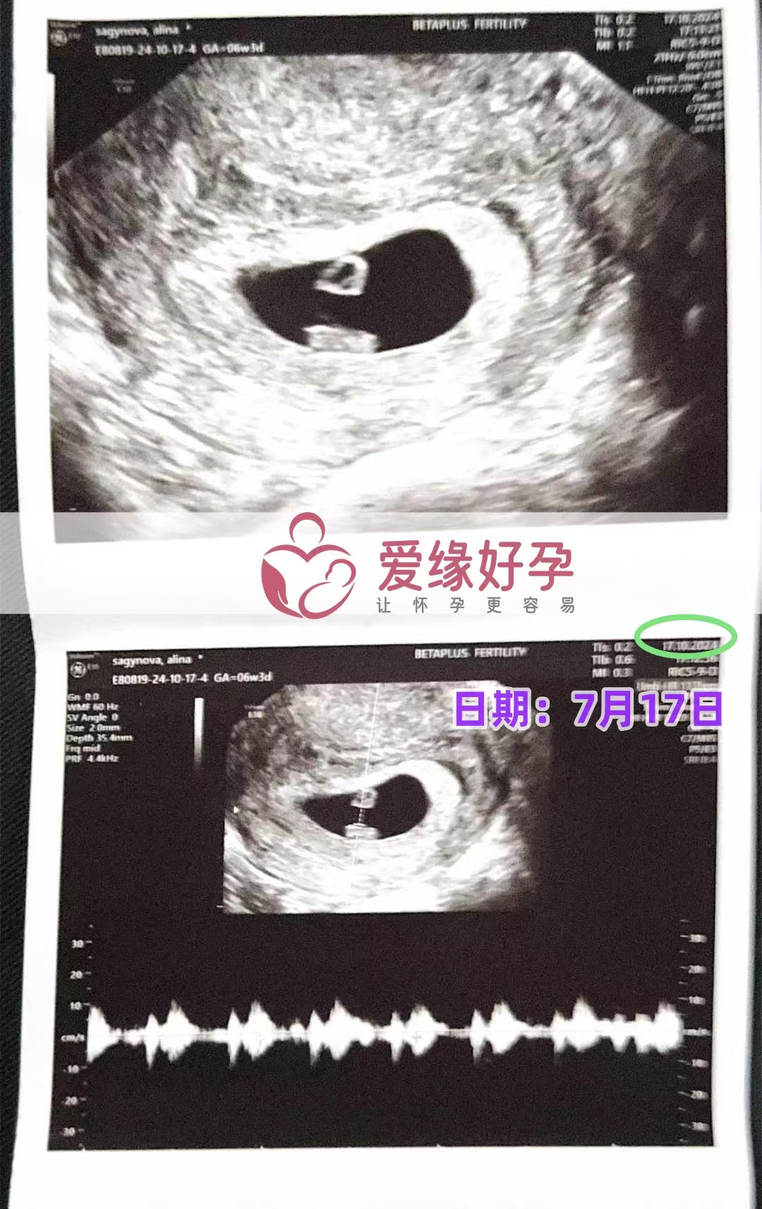 格鲁吉亚代孕代母孕6周产检顺利通过