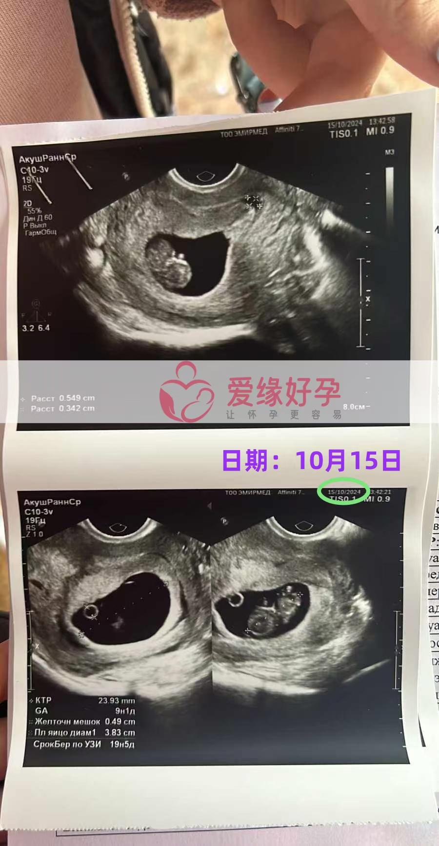 格鲁吉亚代孕代母孕9周产检顺利通过