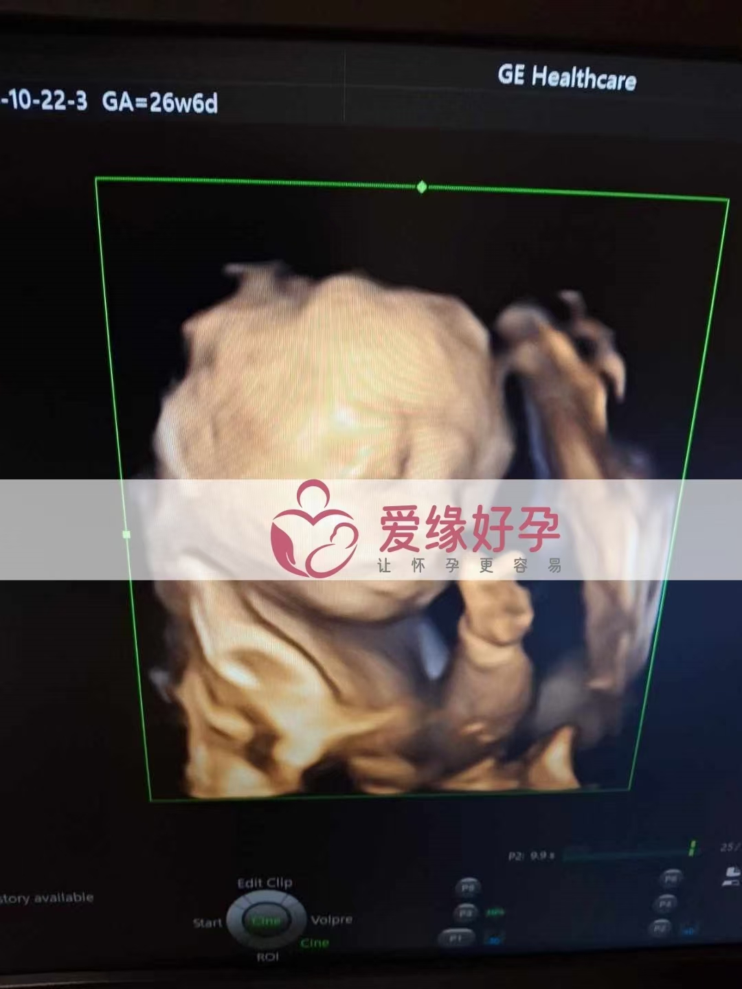 乌克兰代孕代母孕27周产检顺利通过