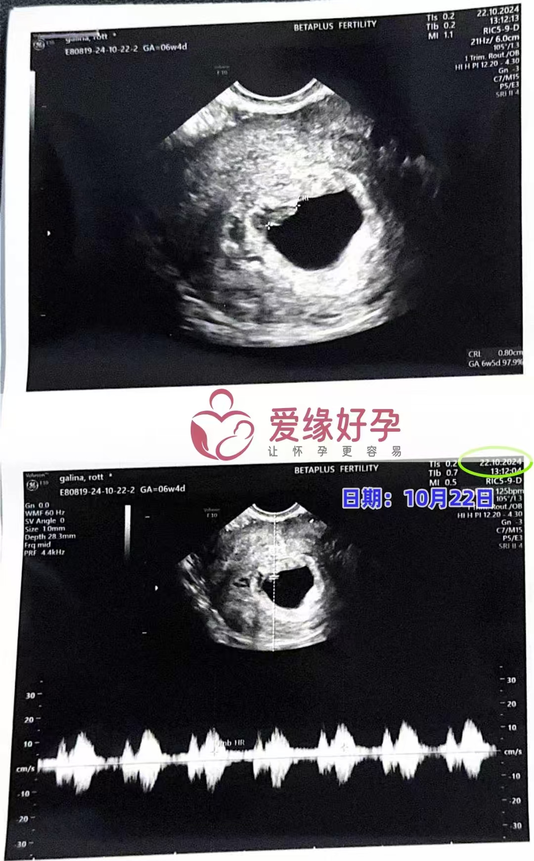 格鲁吉亚代孕代母孕6周产检顺利通过