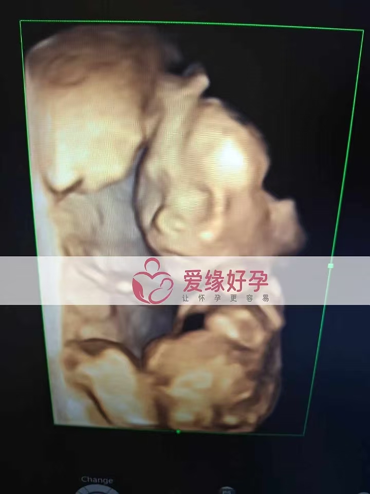 乌克兰代孕代母孕19周产检顺利通过