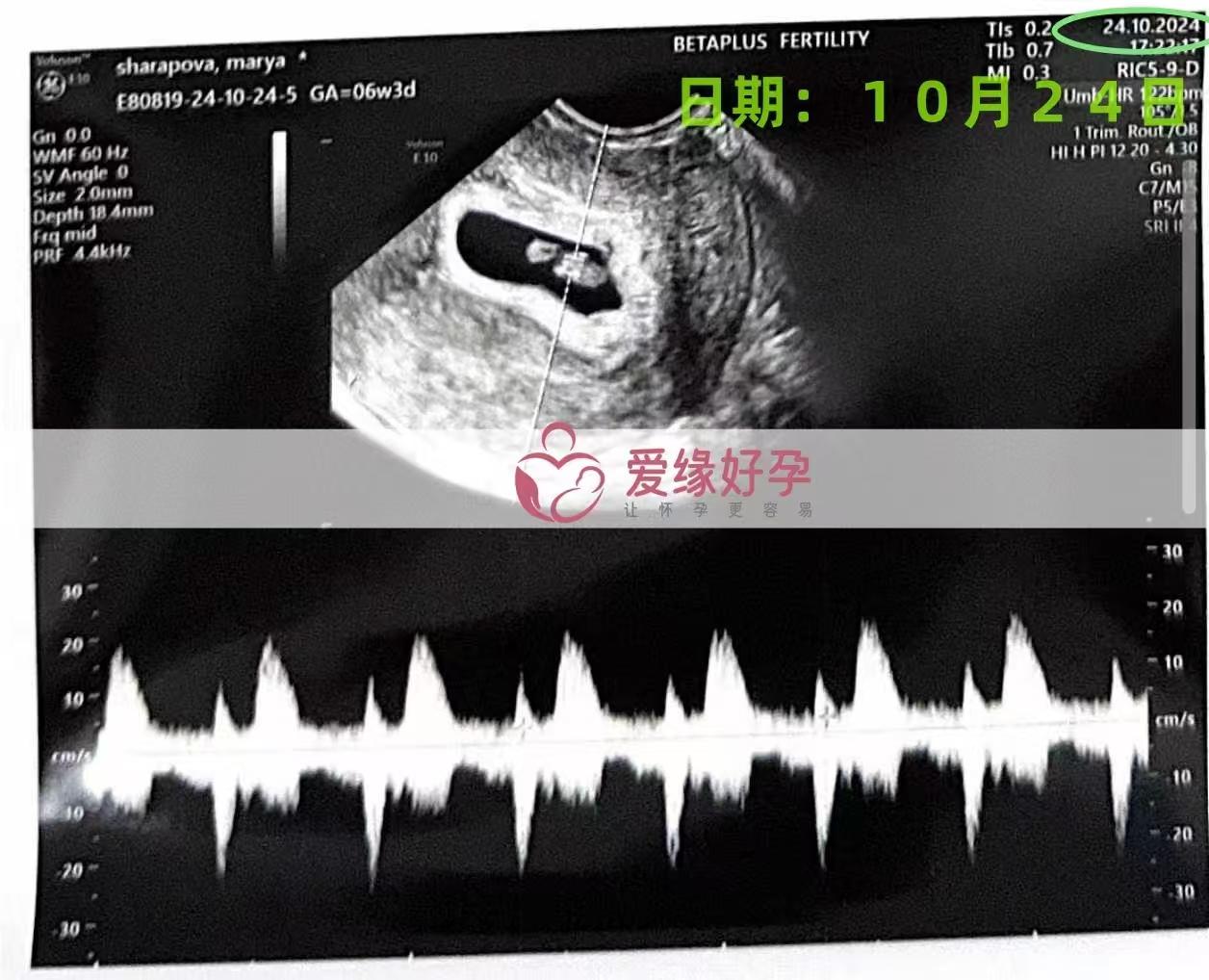 格鲁吉亚代孕代母孕6周产检顺利通过