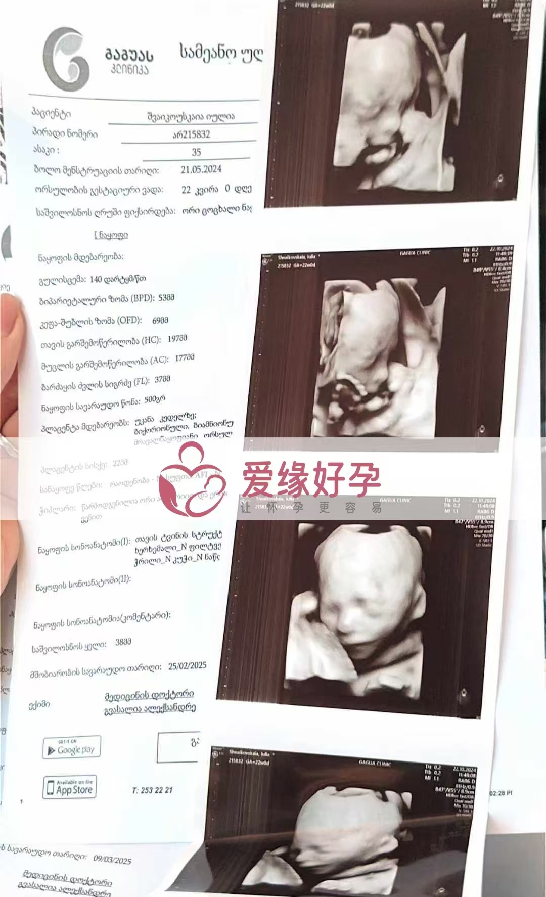 格鲁吉亚代孕代母孕22周产检顺利通过