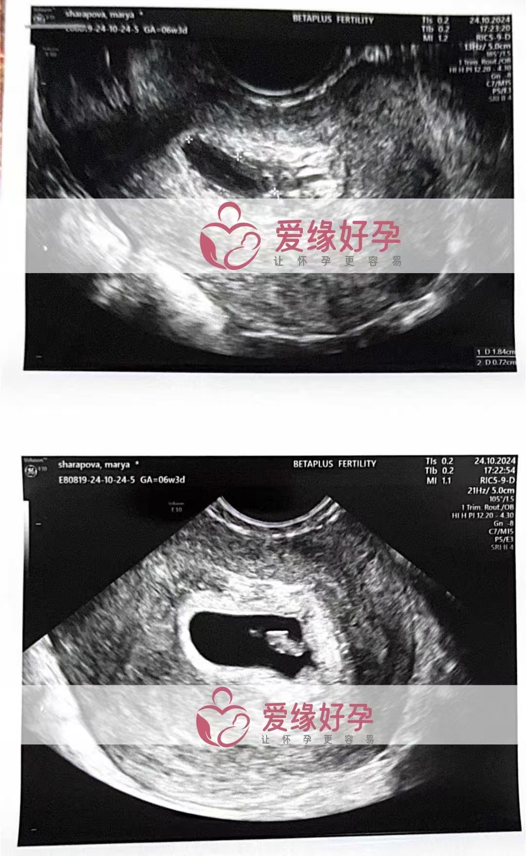格鲁吉亚代孕代母孕6周产检顺利通过