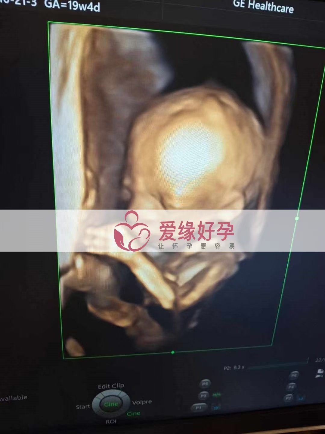 乌克兰代孕代母孕19周产检顺利通过