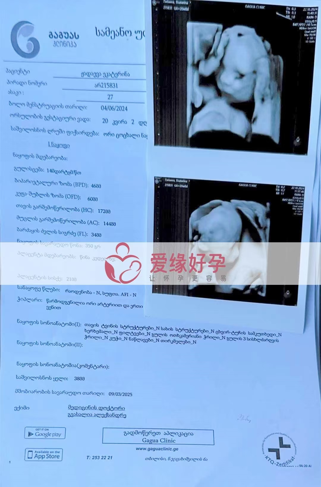 格鲁吉亚代孕代母孕20周产检顺利通过