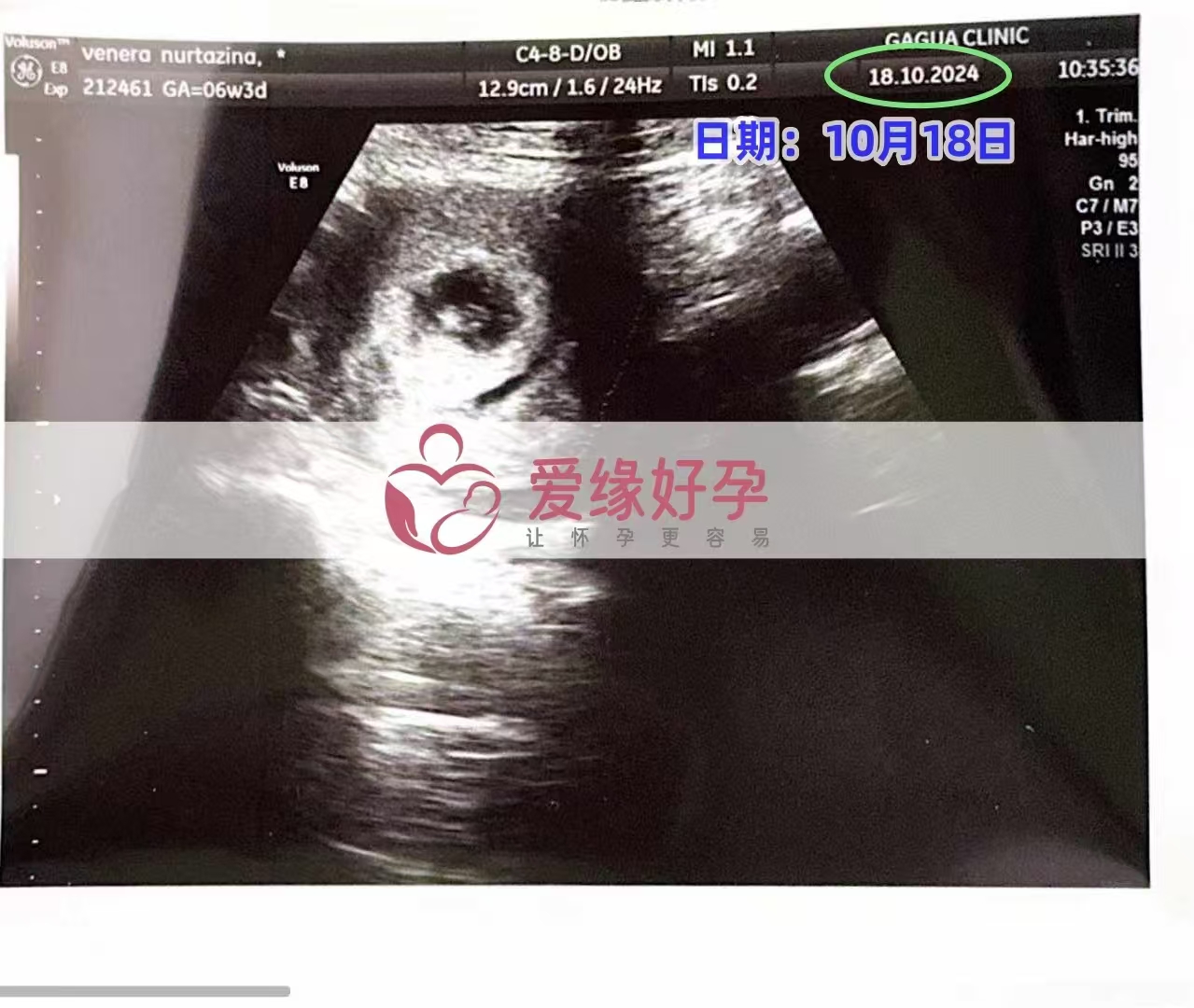格鲁吉亚代孕代母孕6周产检顺利通过