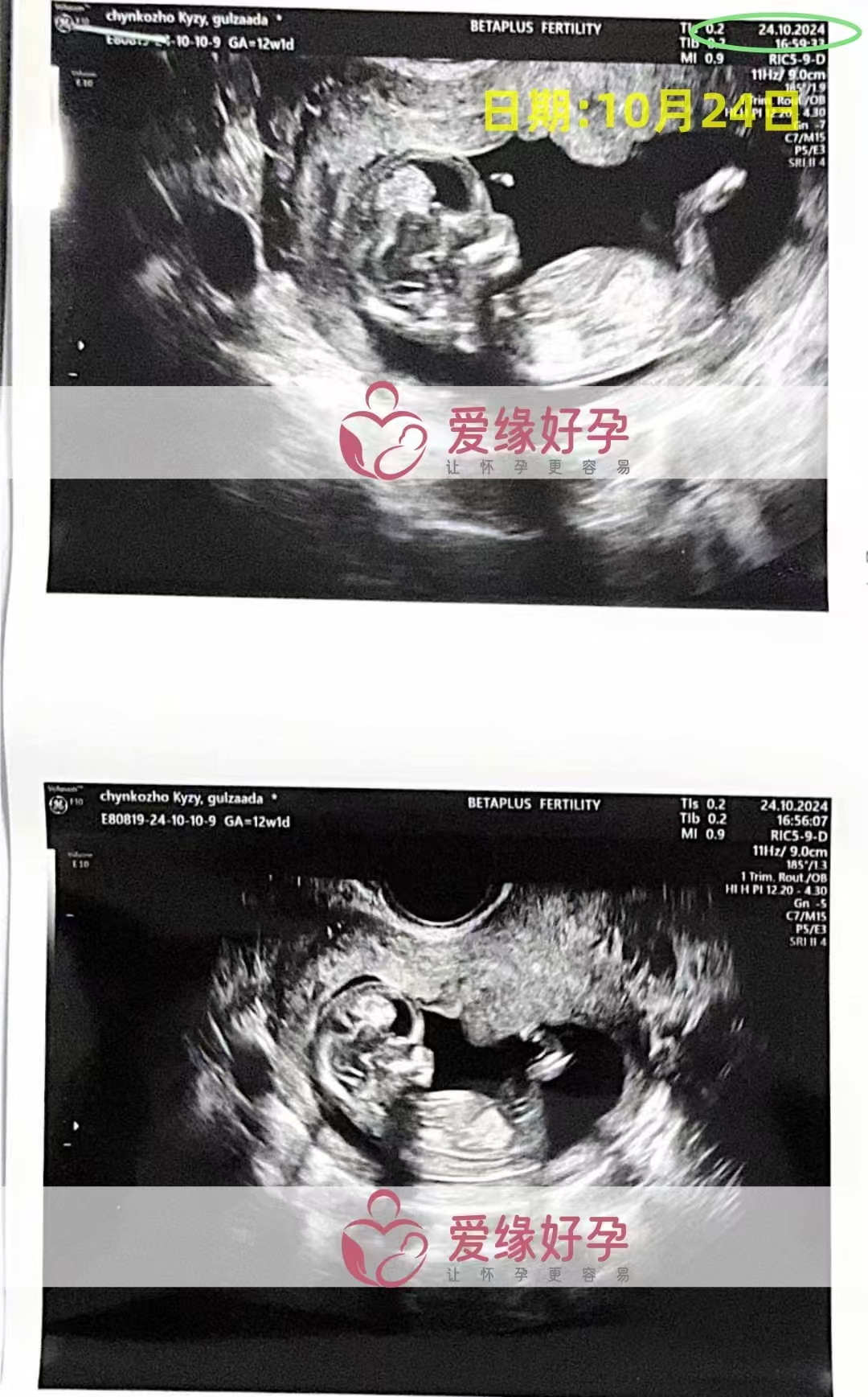格鲁吉亚代孕代母孕12周产检顺利通过