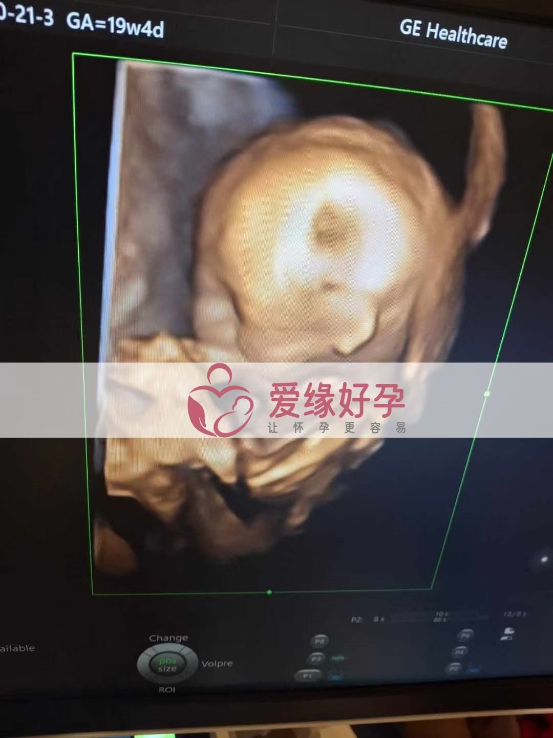 乌克兰代孕代母孕19周产检顺利通过
