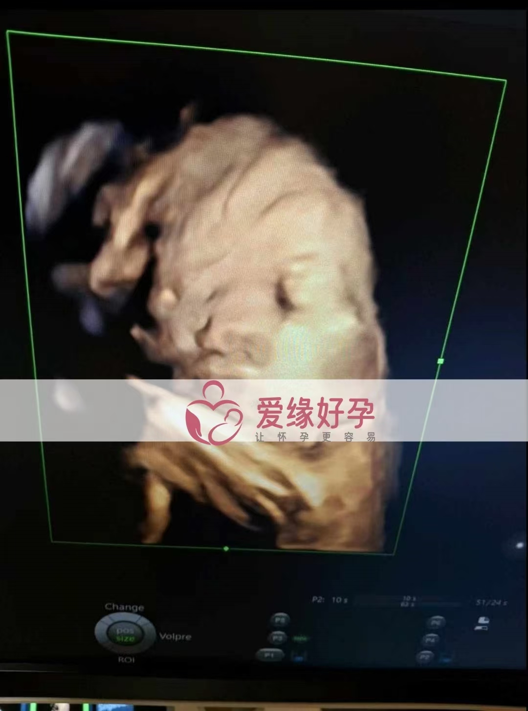 乌克兰代孕代母孕34周产检顺利通过