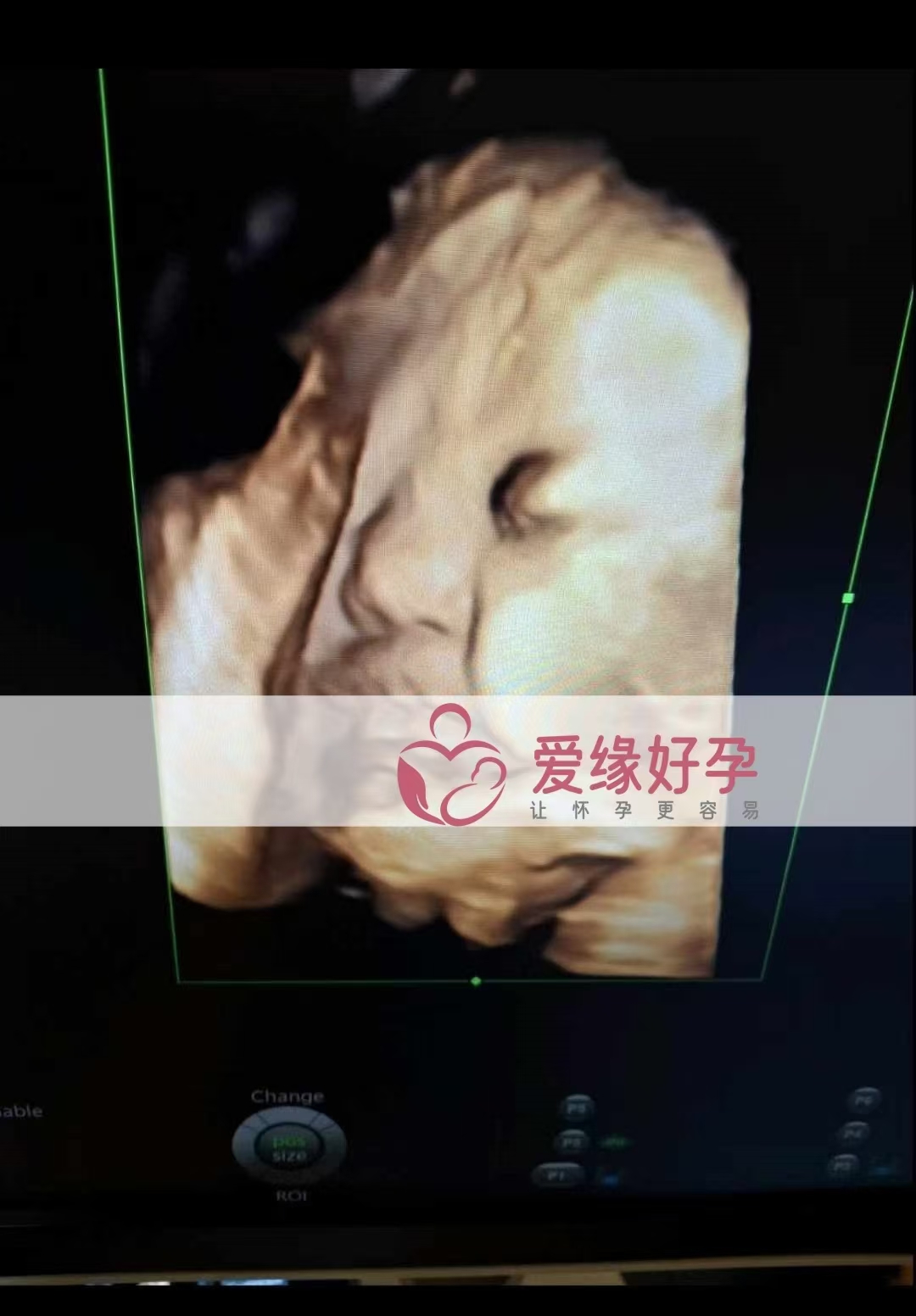 乌克兰代孕代母孕34周产检顺利通过