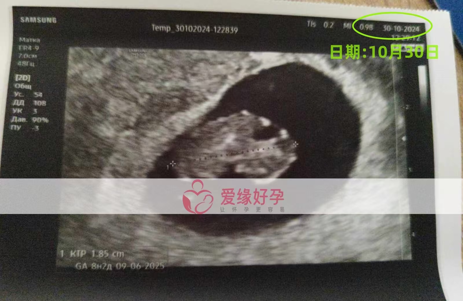 格鲁吉亚代孕代母孕8周产检顺利通过