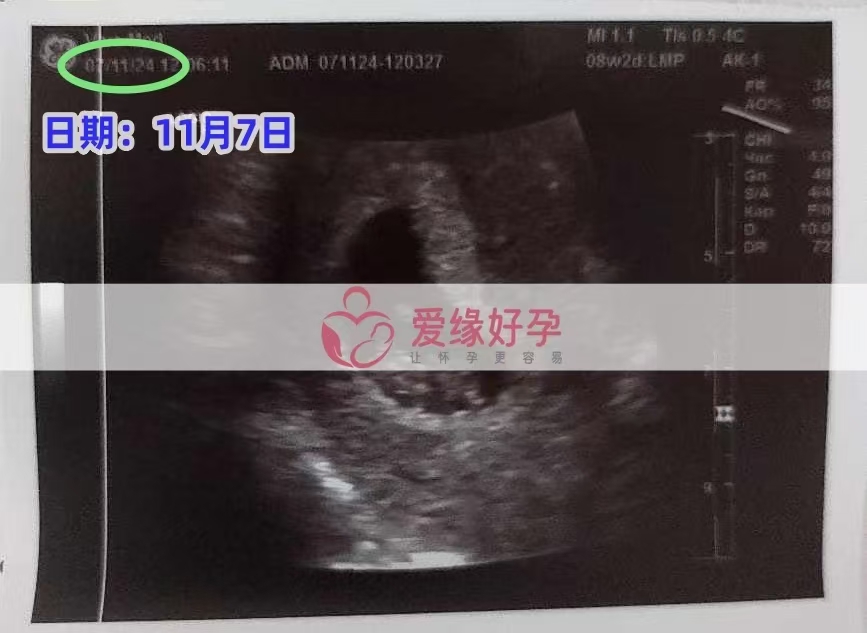 格鲁吉亚代孕代母孕8周产检顺利通过