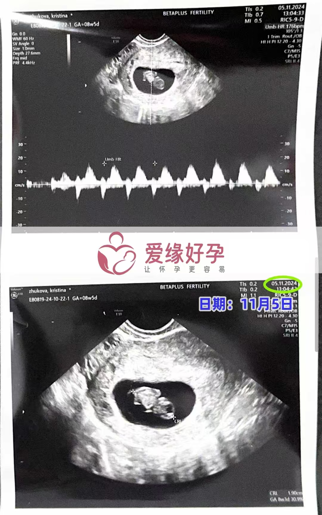 格鲁吉亚代孕代母孕8周产检顺利通过