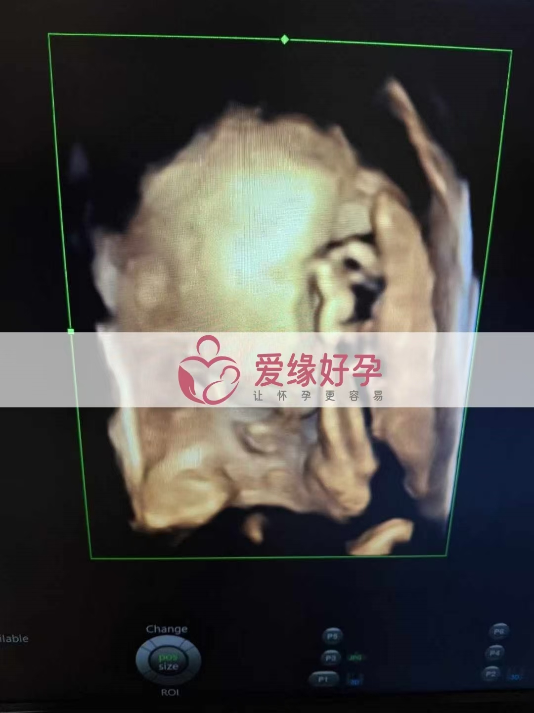 乌克兰代孕代母孕33周产检顺利通过