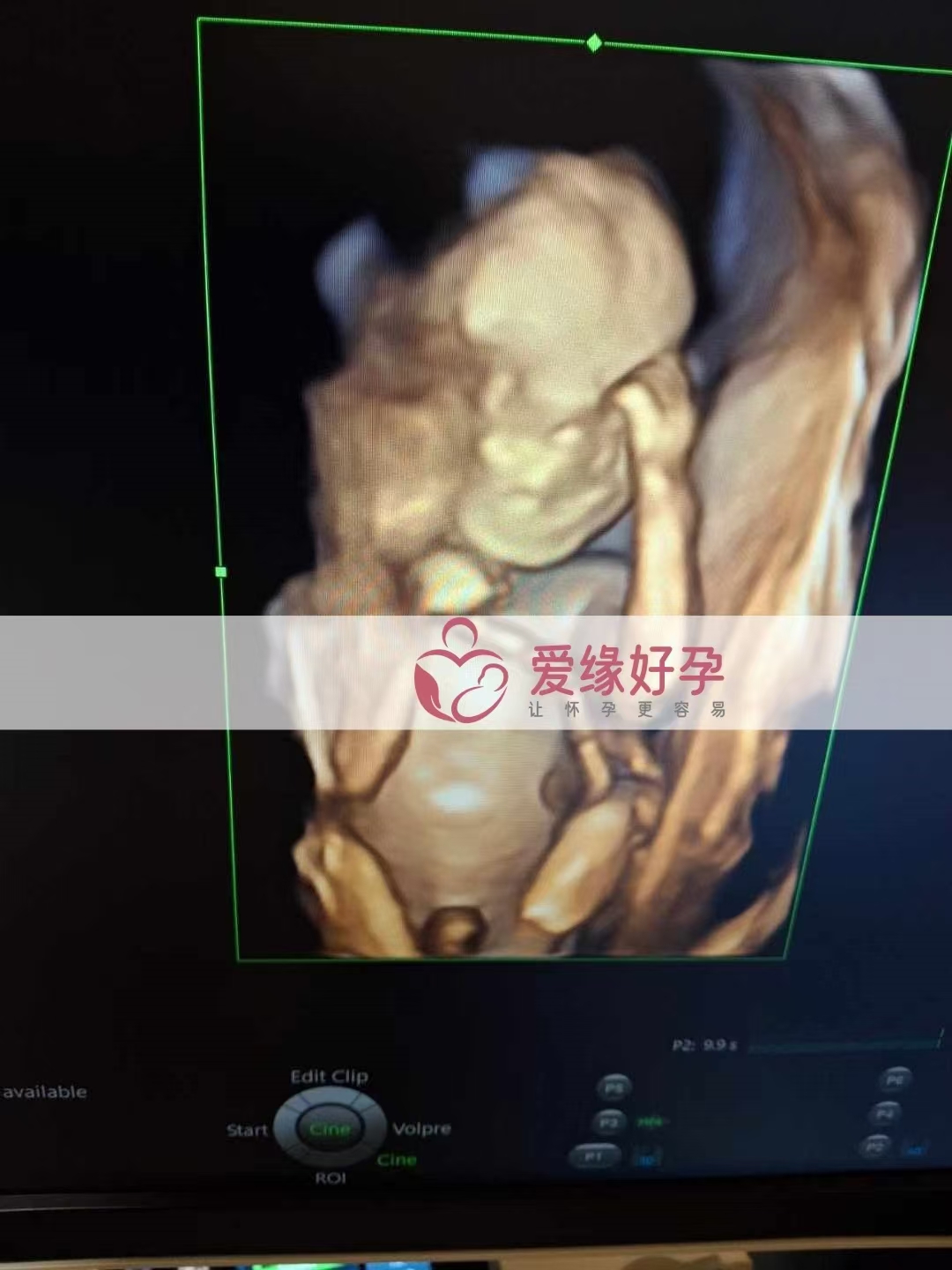 乌克兰代孕代母孕19周产检顺利通过