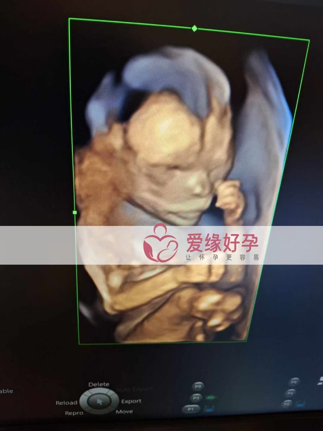 乌克兰代孕代母孕19周产检顺利通过