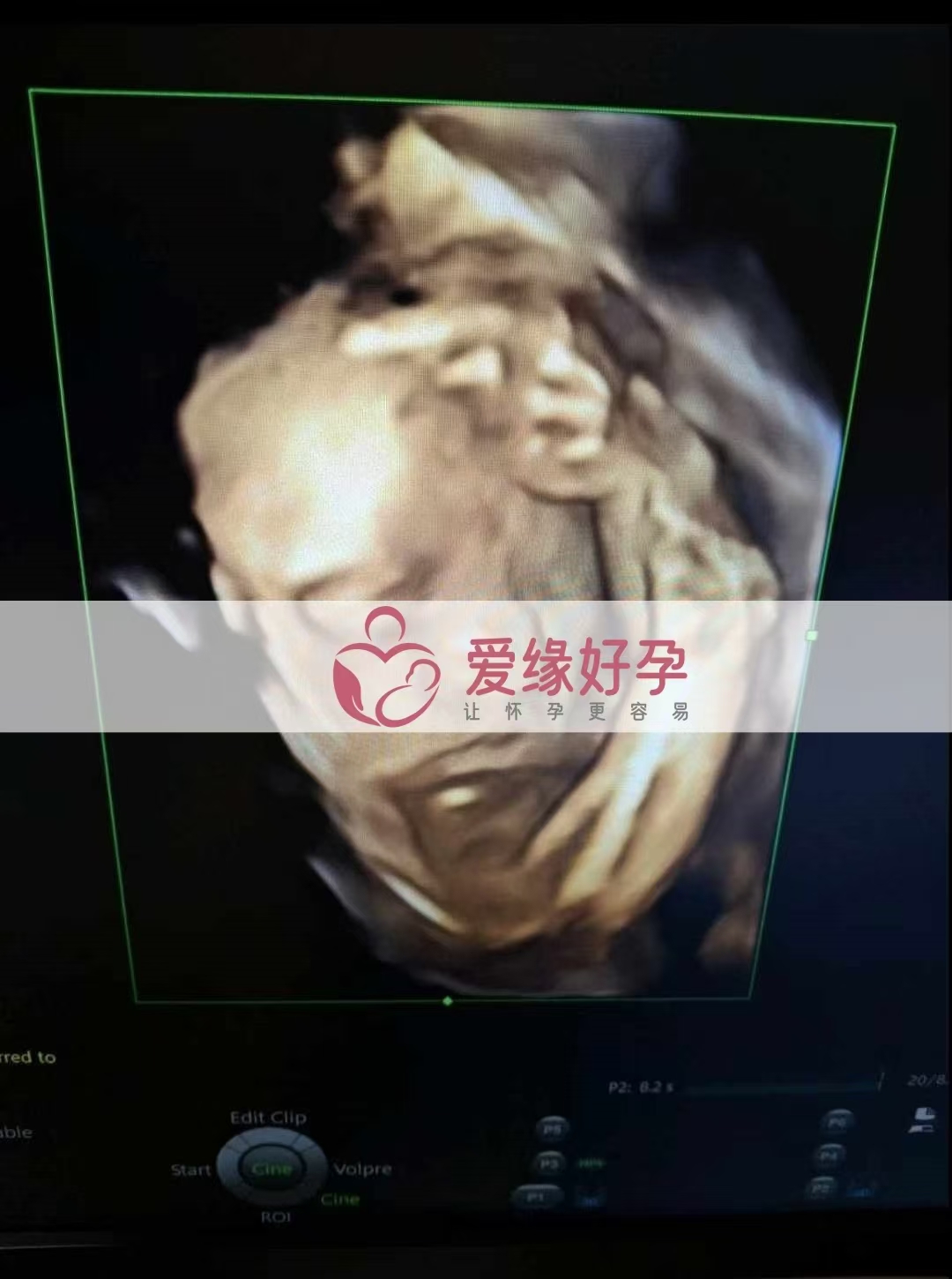 乌克兰代孕代母孕25周产检顺利通过