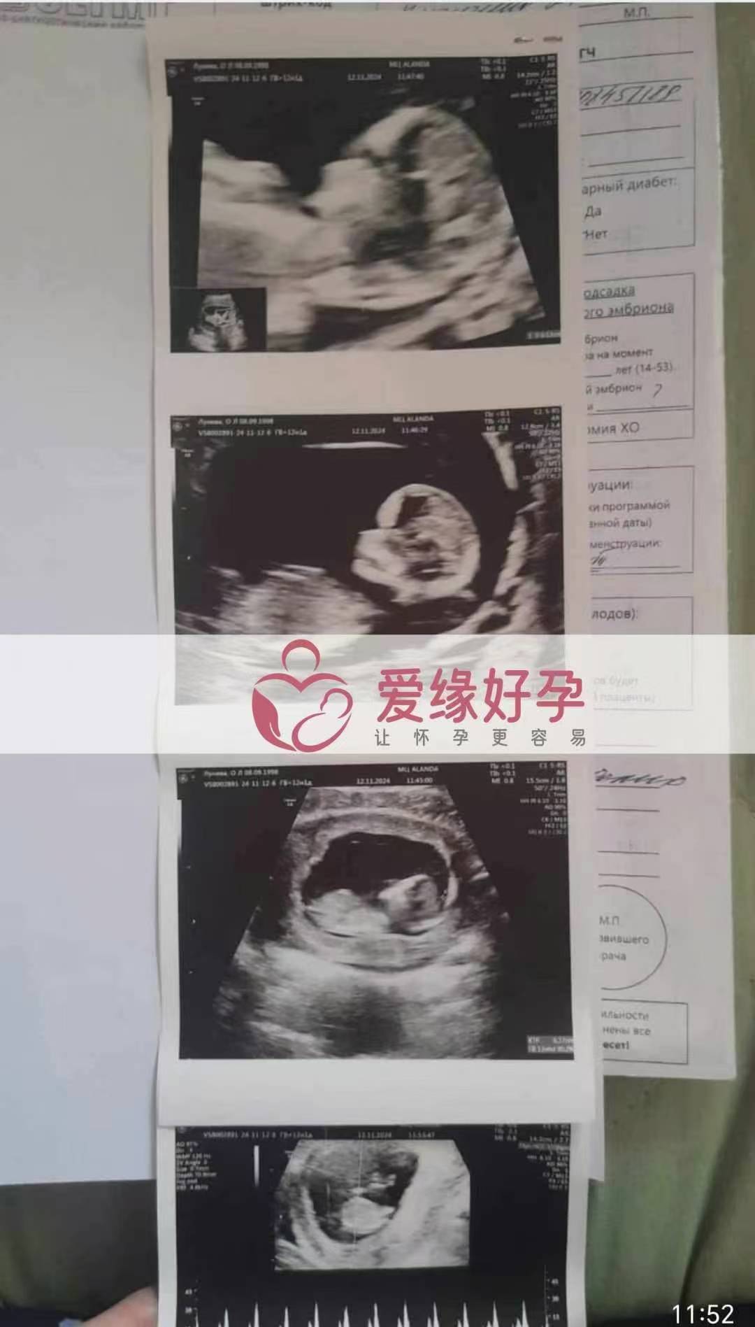 哈萨克斯坦代孕代母NT检测顺利通过