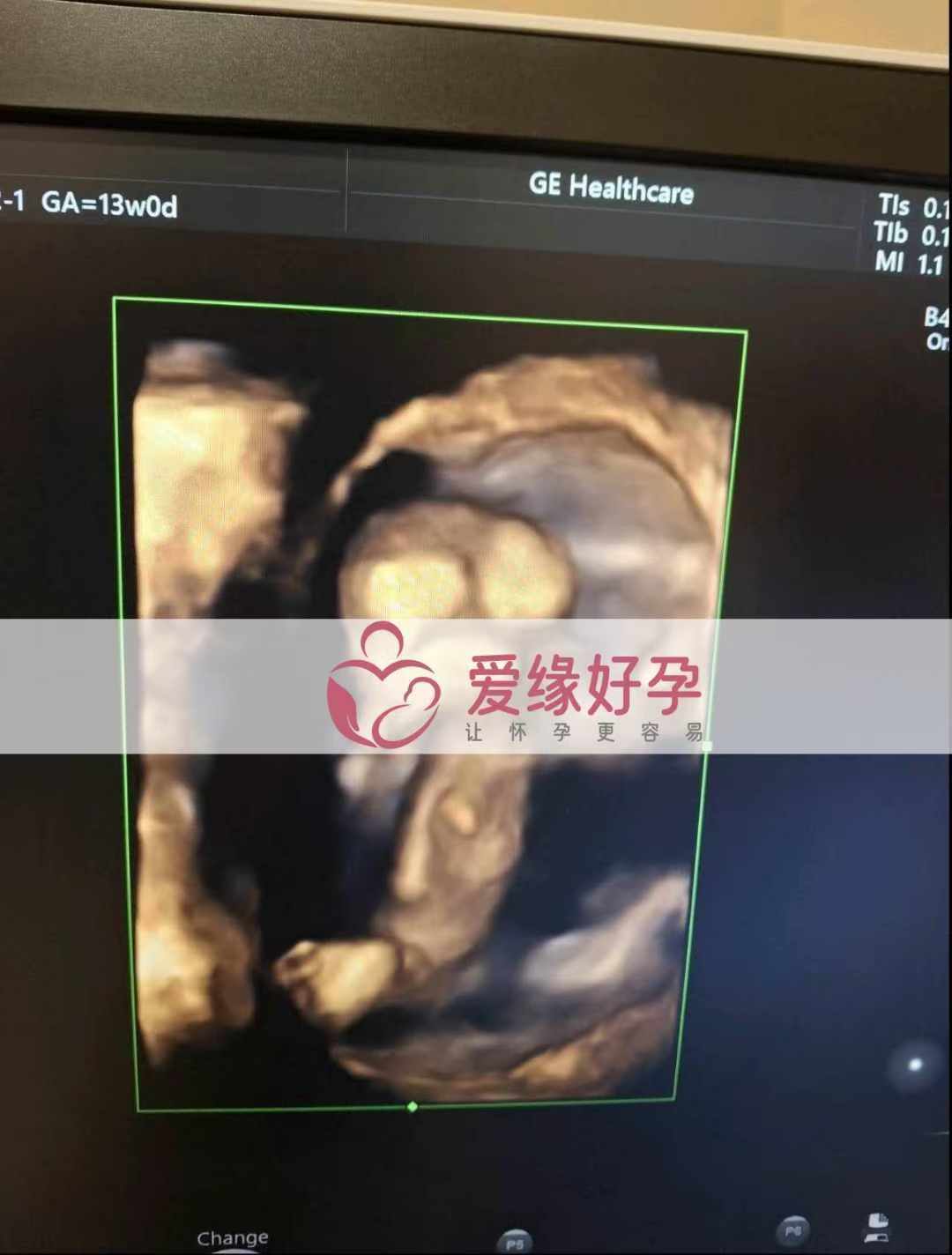 乌克兰代孕代母孕15周产检顺利通过