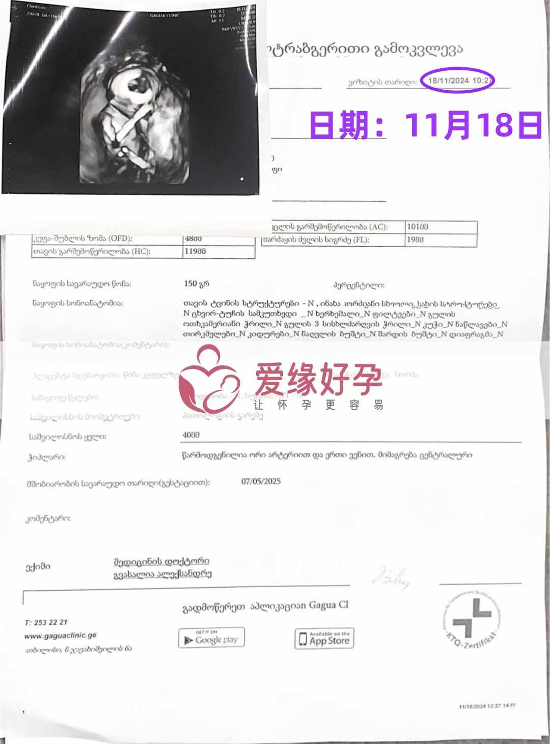 格鲁吉亚代孕代母孕15周产检顺利通过