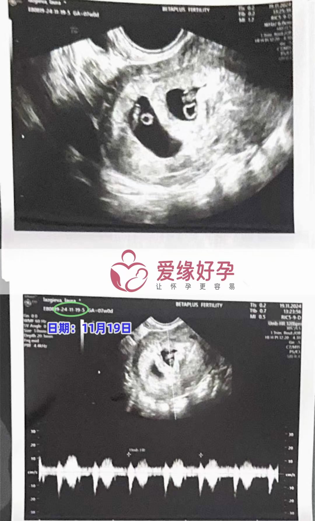 格鲁吉亚代孕代母双胎第一次B超顺利通过