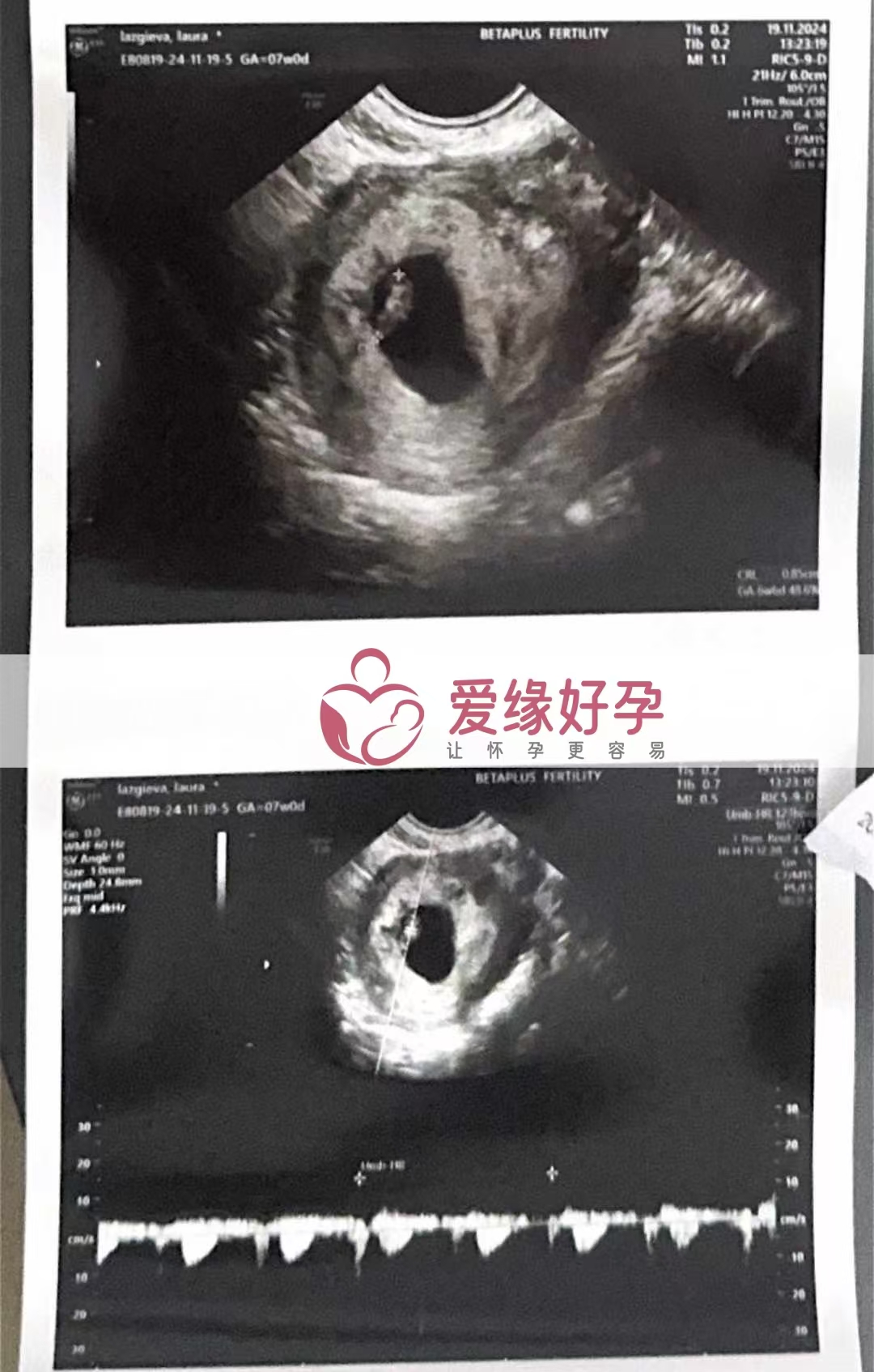 格鲁吉亚代孕代母双胎第一次B超顺利通过