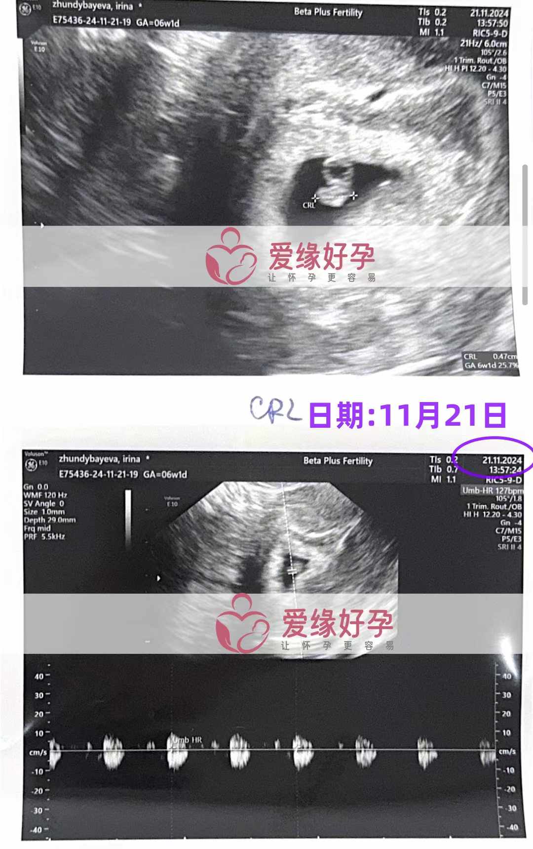 格鲁吉亚代孕代母孕6周产检通过