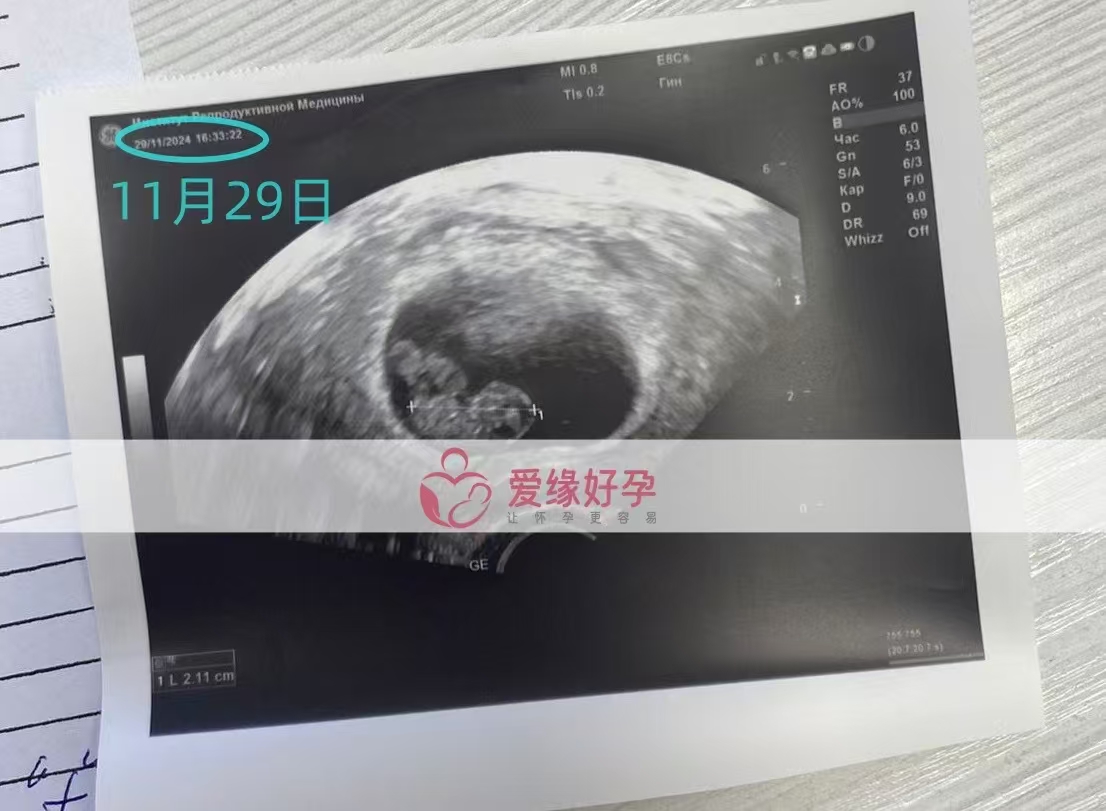哈萨克斯坦代孕代母孕后2次B超检查顺利通过
