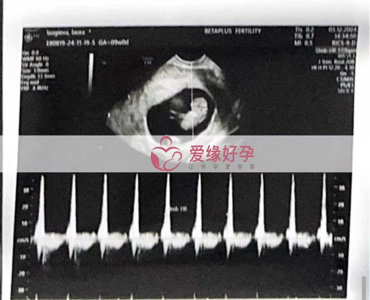 格鲁吉亚代孕代母孕8周产检顺利通过