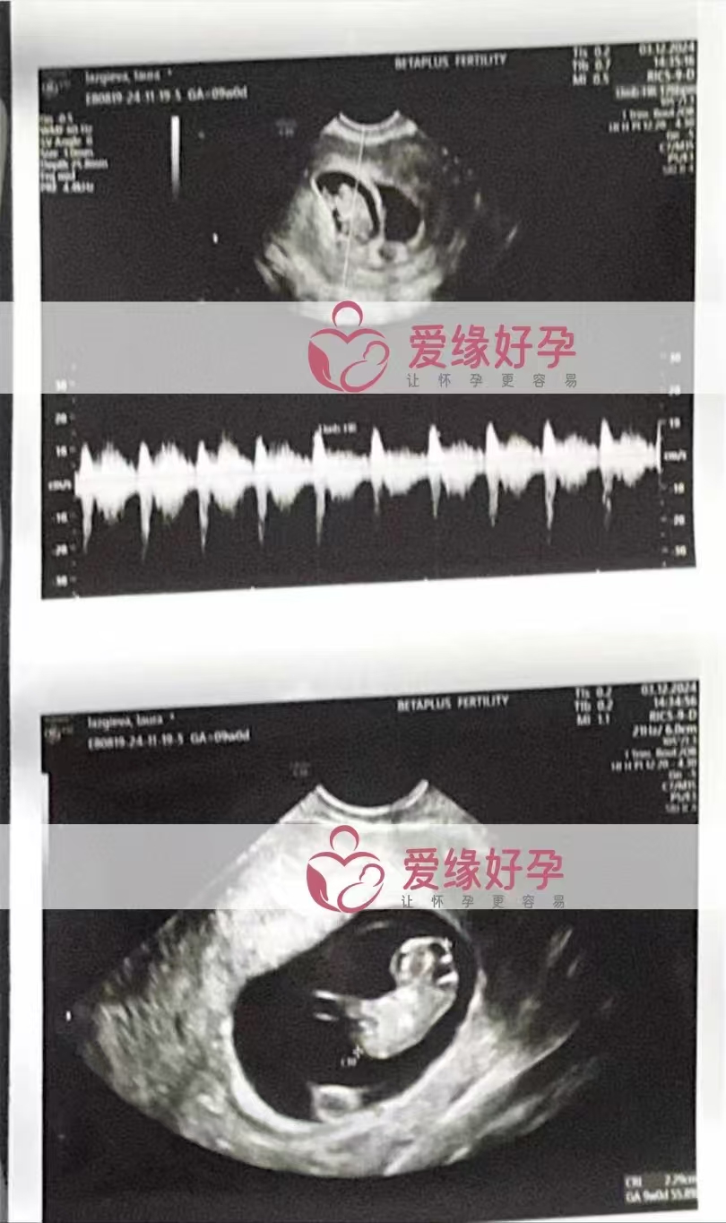 格鲁吉亚代孕代母孕8周产检顺利通过