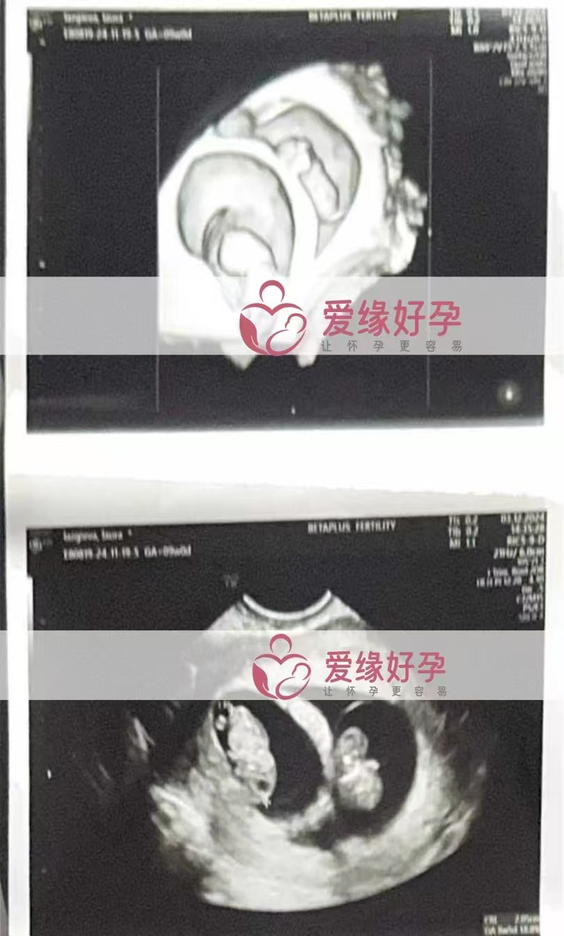 格鲁吉亚代孕代母孕8周产检顺利通过