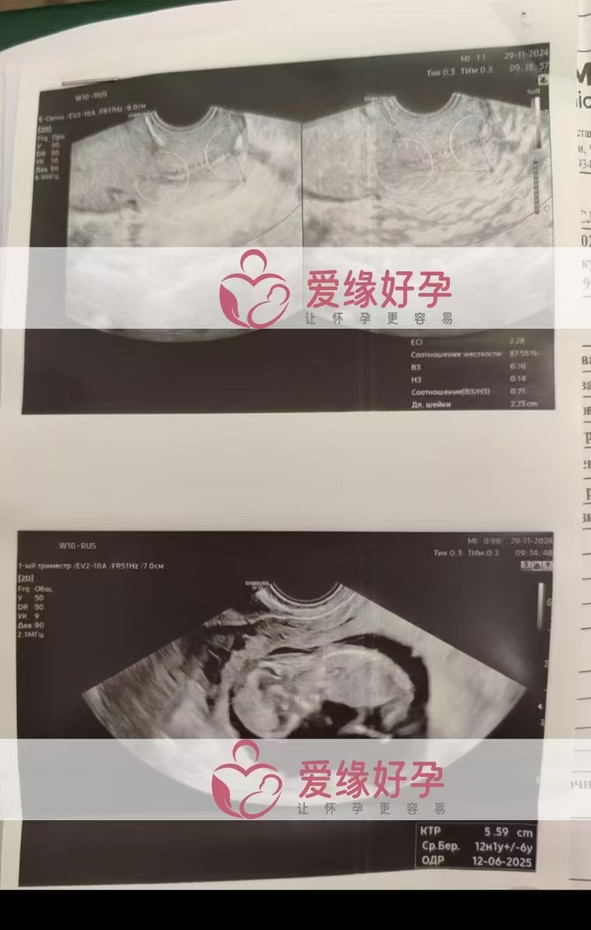 哈萨克斯坦代孕代母孕12周产检顺利通过